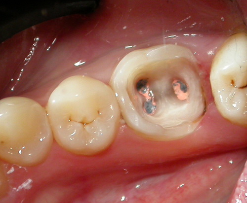 46 зуб анатомия каналов стоматология золотое яблоко томск